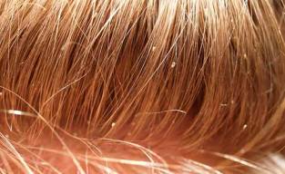how to get rid of head lice?